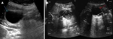 Other symptoms you may notice include: Rare Cystic Liver Lesions A Diagnostic And Managing Challenge