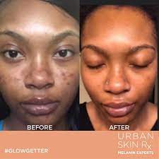 Pin On Dark Spots And Hyperpigmentation