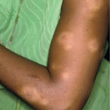 Image result for Postinflammatory Hypopigmentation