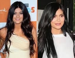 How long do lip fillers last? What Happens To Lips When You Remove Lip Filler Hellogiggles