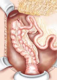 Eleven patients with benign postoperative colonic strictures were treated with balloon dilatation november, 1990, through november, 1995. Remedial Surgery Following Failed Colorectal Or Coloanal Anastomosis Abdominal Key