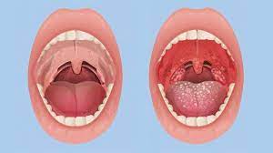 Tonsilitis akut adalah radang akut yang disebabkan oleh kuman streptococcus β hemolyticus, treptococcus viridans dan streptococcus pyogenes, dapat juga. Gejala Penyakit Amandel Penyebab Dan Cara Pengobatannya Menular Dan Sering Terjadi Pada Anak Halaman All Tribun Jogja