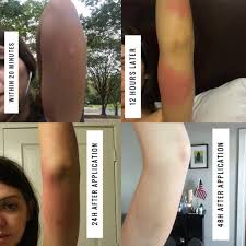 Skeeter syndrome, the name may sound unique but it, in fact, refers to something most of us experience more often than we think. The Natural Wonder Balm You Need For Mosquito Bites