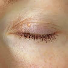 Image result for xantelasma