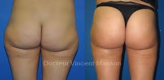 Avec le lipofilling, la graisse peut être utilisée pour avec le lipofilling (=lipotransfert), la graisse est prélevée sur le corps du patient et utilisée pour combler les rides, plis et creux situés ailleurs. Chirurgie Des Fesses A Paris Docteur Vincent Masson