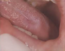 Image result for Leukoedema