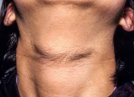 Image result for Hypertrichosis