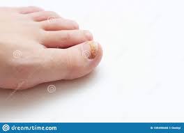 Cómo cortarse las uñas de los pies uñas largas long nails uñas largasno tires tus uñas colecciónalas. Pie Con Hongo De Unas Aislado En Fondo Blanco Foto De Archivo Imagen De Enfermedad Dedo 169495668
