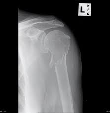 The upright position may be more comfortable than the table for some patients. X Ray Vision Shoulders And Elbows Taming The Sru