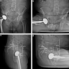 The bony pelvis & gender differences in pelvic anatomy. Pelvis And Total Hip Arthroplasty Acetabular Component Orientations In Sitting And Standing Positions Measurements Reproductibility With Eos Imaging System Versus Conventional Radiographies Sciencedirect