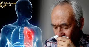 The symptoms of lung cancer range, like a chronic cough, can be easy to ignore or dismiss, but doing so can delay vital treatment. Lung Cancer Symptoms If This Happens To Your Fingers You Could Have The Deadly Disease