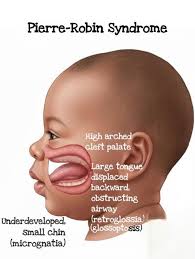 Image result for Micrognathia