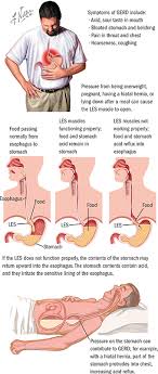 Gerd Pain Diagram Wiring Diagrams