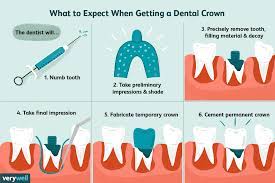 A single tooth can have up to four roots, and a root may split into two. Getting A Dental Crown On Your Tooth