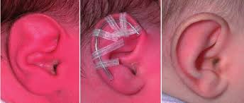 The price varies per location, whether done by a doctor or by a tattoo and piercing artist, among others. Stahl S Ear Tablon