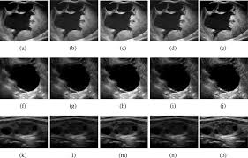 But ovarian cancer sometimes takes a while to diagnose because of the need to rule out other medical conditions. Three Real Ultrasound Images A Abdomen Ovary Cancer Image 574 Download Scientific Diagram