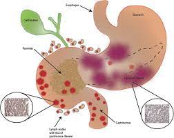 Case Report Optimal Tumor Cytoreduction And Octreotide With Durable Disease Control In A Patient With Men 1 And Zollinger Ellison Syndrome Over A Decade Of Follow Up World Journal Of Surgical Oncology Full Text