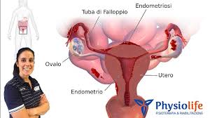 Endometriosis is a full body condition in which cells similar to those in the endometrium, the layer of tissue that normally covers the inside of the uterus, grow outside the uterus. L Endometriosi E L Osteopatia Physiolife Velletri