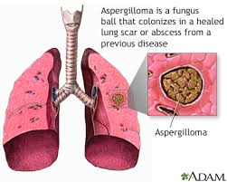 New guidelines for the management of aspergillosis. Aspergillosis Information Mount Sinai New York