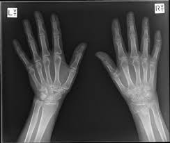 Complex Regional Pain Syndrome Radiology Reference Article Radiopaedia Org