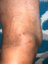 However, the sooner a person seeks help, the lower the. Help Does This Look Like A Spider Bite Burning Sensation And Hurts To Touch Spiderbites