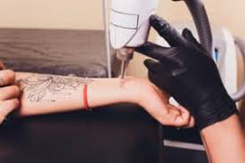 Most insurance carriers will not pay for tattoo removal unless it is medically required. Why Does Tattoo Removal Cost So Much To Have Done Inkedmind
