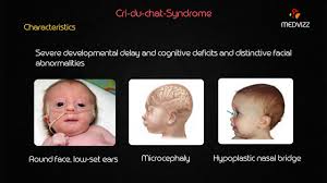 The symptoms of cri du chat syndrome vary among individuals. Cri Du Chat Syndrome Usmle Step 1 Lecture Youtube