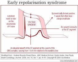 Image result for Early Repolarization