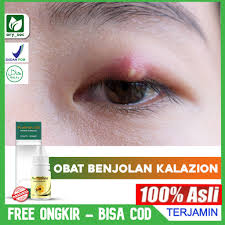 8 penyebab mata bengkak, dari yang jinak hingga berbahaya. Obat Kalazion Sakit Mata Bintitan Menahun Benjolan Kelopak Mata Bengkak Paling Bagus Propolis Sm Shopee Indonesia