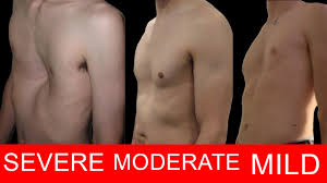 Image result for Pectus Excavatum