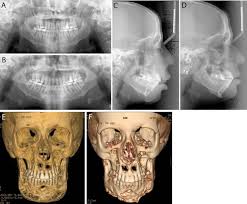 Cherubism is a disorder characterized by abnormal bone tissue in the jaw. Cherubism Best Clinical Practice Orphanet Journal Of Rare Diseases Full Text