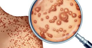 Image result for Monkeypox