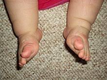 In some children, clubfoot deformity occurs as a symptom of another disorder. Clubfoot Wikipedia