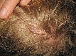 Dry Scalp At The Crown Of The Head Treatments That Work Lice Removal Dry Scalp Dandruff