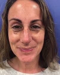 Paul H. Rosenberg MD Palisade Plastic Surgery Associates