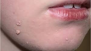 There are several safe ways to remove skin tags at home. Skin Tags On Lips Causes And Treatment