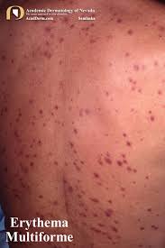 Image result for Erythema Multiforme Major