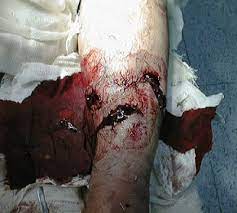 Open Fractures Classification Management Teachmesurgery