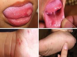 Ruam umumnya muncul pada telapak tangan dan kaki, dan juga dapat muncul pada bokong dan/atau kelamin. Penyakit Tangan Kaki Dan Mulut Hfmd Pembunuh Bersiri Kanak Kanak Sentiasa Panas