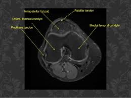 It is the largest synovial joint in the body and allows flexion and extension of the leg as well as some rotation in the flexed position. Lateral Vs Medial Anatomy Shefalitayal