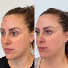 BBL Laser in Marlton