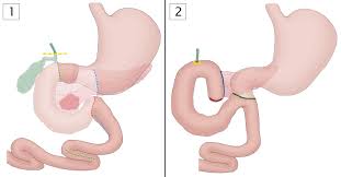 The two most commonly used types for pancreatic cancer are: Pancreatic Cancer Amboss