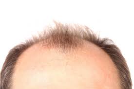 Will minoxidil work for a receding hairline? Baldness How Close Are We To A Cure