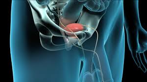 Although it is the most commonly diagnosed cancer in american women, breast cancer can impact people of all genders. Radical Prostatectomy Prostate Cancer Surgery Youtube
