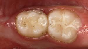 Pokémon go (samsung galaxy apps version) 0.213.0. Glass Ionomer Cements For Primary Teeth Pediatric Dentistry Dental News