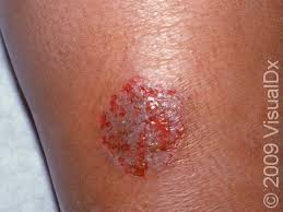 Image result for Eczema nummulare