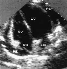 When you have an infection, your immune system produces special. Echocardiography In Chagas Heart Disease Circulation