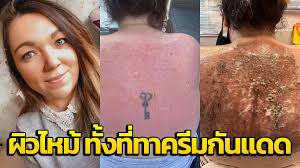 หญิงคนนี้ลงเอยที่โรงพยาบาล ด้วยอาการผิวไหม้ที่ 'น่ากลัว' ทั้งๆ  ที่ใช้ครีมกันแดด ' SPF 30 ทั้งวัน'