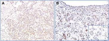 Most of the patients (17) had the epithelioid type of mesothelioma, 2 had the sarcomatoid variety, and 3 were identified as biphasic. Brca1 Associated Protein 1 Bap1 Immunohistochemical Expression As A Diagnostic Tool In Malignant Pleural Mesothelioma Classification A Large Retrospective Study Sciencedirect