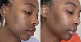 Salicylic acid, what's the difference? Azelaic Acid What Is It How Do You Use It Best To Buy